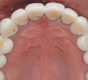 occlusal disease