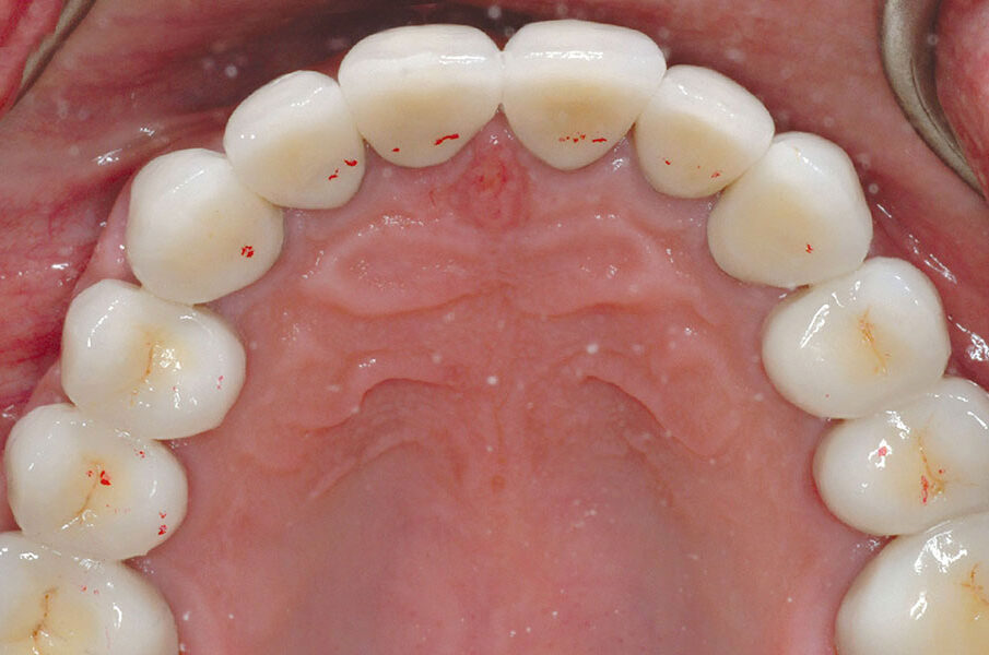 occlusal disease