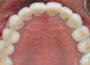 occlusal disease