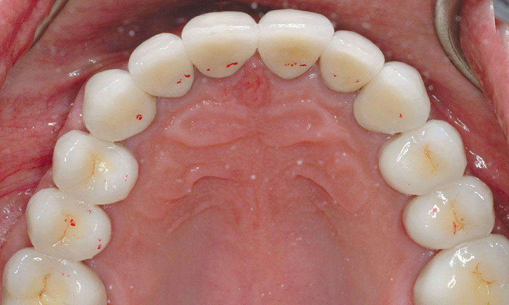 occlusal disease